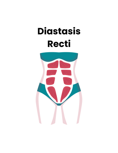 Link to: Diastasis Recti 