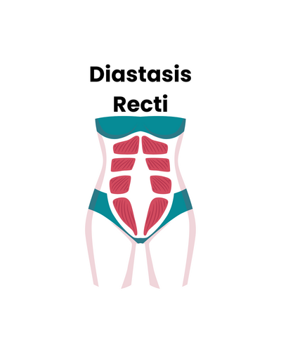 Link to: https://prosperpts.com/diastasis-recti